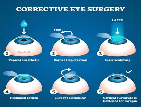 how much is lasik surgery.